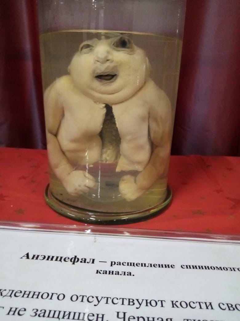 Аненцефалия