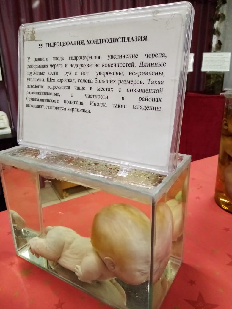 Гидроцефалия