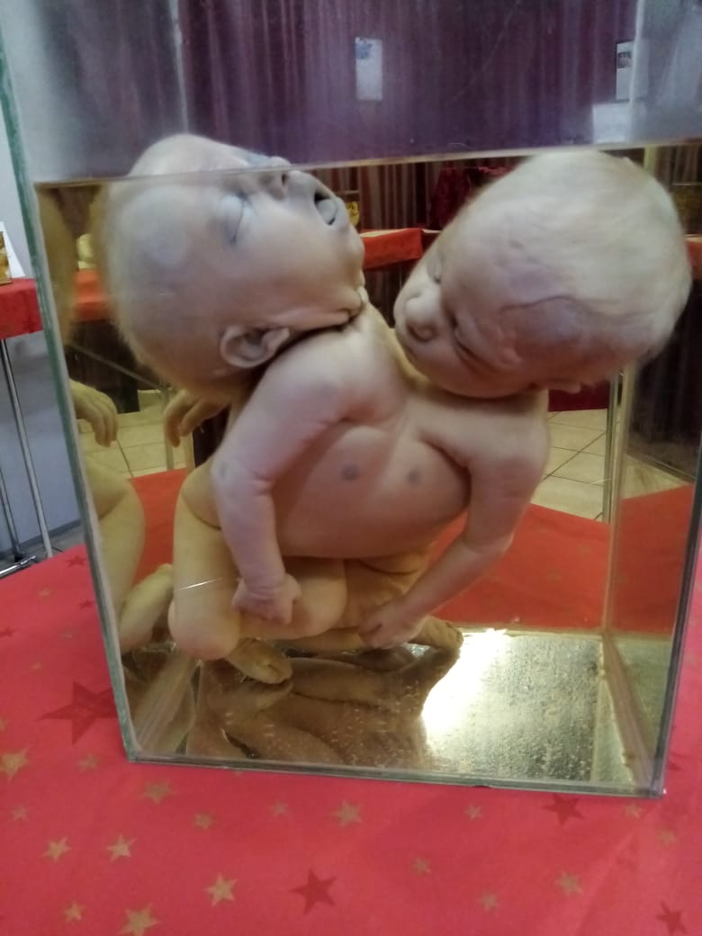 Сиамские близнецы